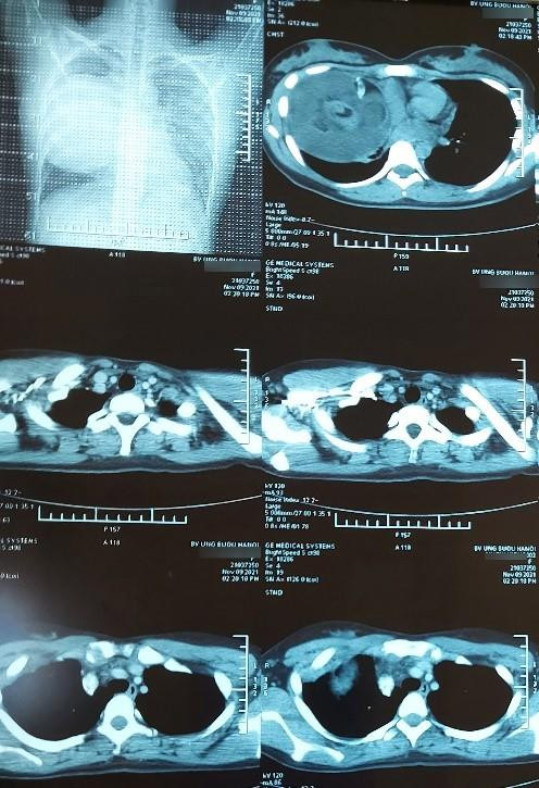 Phim chụp trước và sau phẫu thuật của bệnh nhân Phim chụp trước và sau phẫu thuật của bệnh nhân