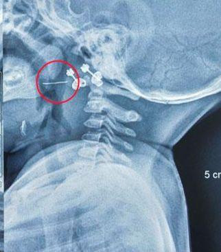 Hình chụp sợi thép xuyên qua Amidan trái của trẻ