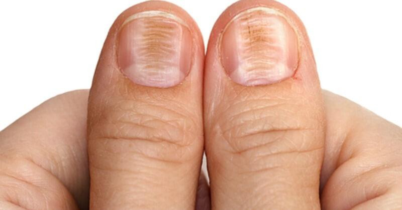 Móng tay gợn sóng có thể là dấu hiệu của bệnh vảy nến hoặc viêm khớp