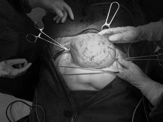 Khối u của người phụ nữ to gần bằng quả bóng. Ảnh: Bệnh viện cung cấp Khối u của người phụ nữ to gần bằng quả bóng. Ảnh: Bệnh viện cung cấp