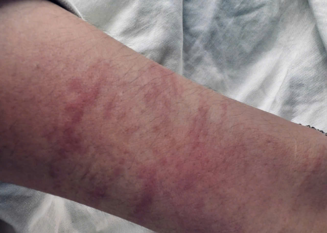 Chị H. bị trầy xước ở tay trong lúc bị xâm hại Chị H. bị trầy xước ở tay trong lúc bị xâm hại