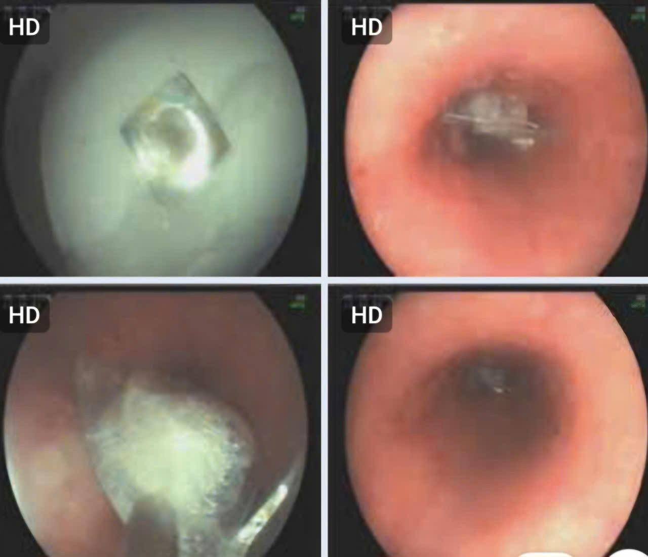 Hình ảnh dị vật là vỏ thuốc trong thực quản bệnh nhân M. Hình ảnh dị vật là vỏ thuốc trong thực quản bệnh nhân M.