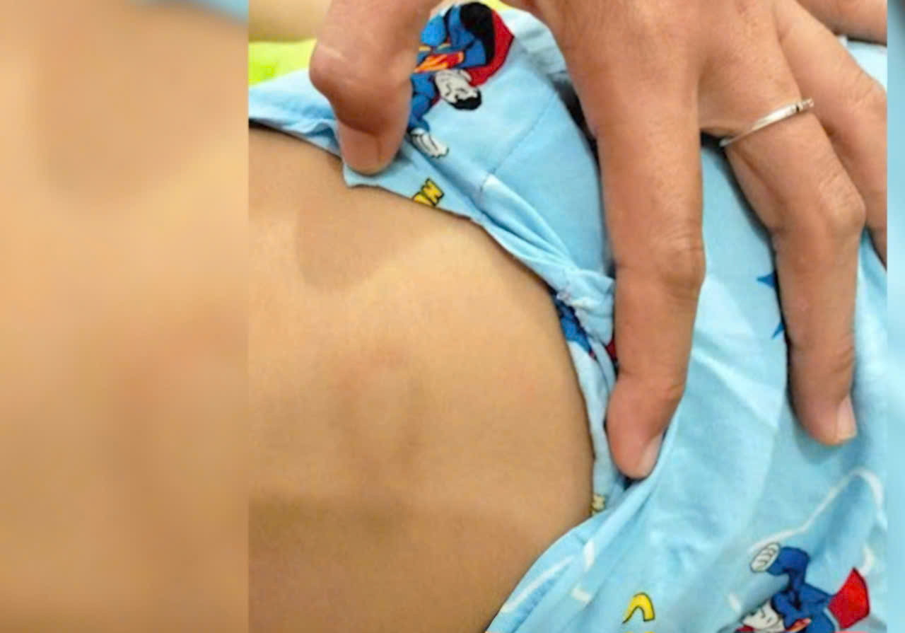 Dấu vết bầm trên lưng cháu A. Dấu vết bầm trên lưng cháu A.