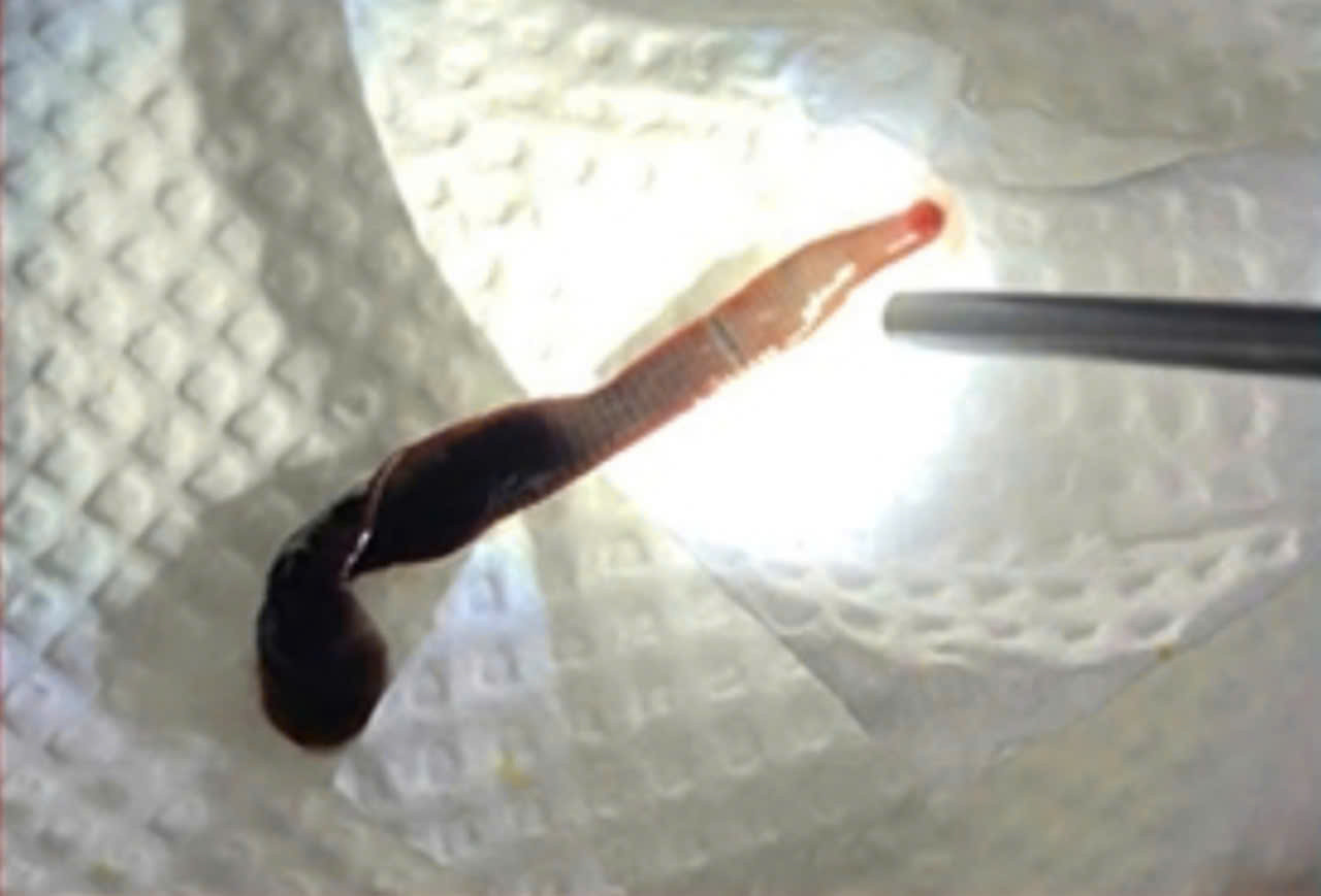 Con vắt dài 8cm được lấy ra từ mũi bệnh nhân Q. Con vắt dài 8cm được lấy ra từ mũi bệnh nhân Q.