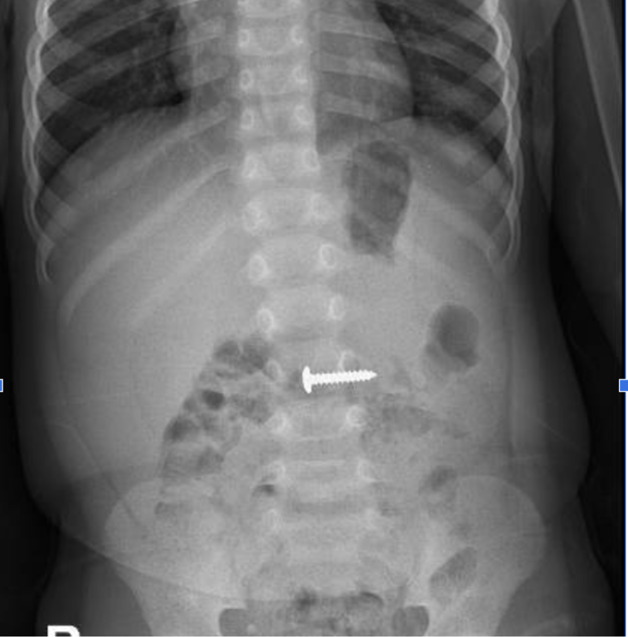 Hình ảnh chụp X-quang của bệnh nhi H. Ảnh: BVĐKQT