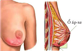 Các bệnh tuyến vú lành tính ảnh 1