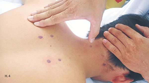 Xoa bóp chữa đau vai gáy hiệu quả ảnh 4