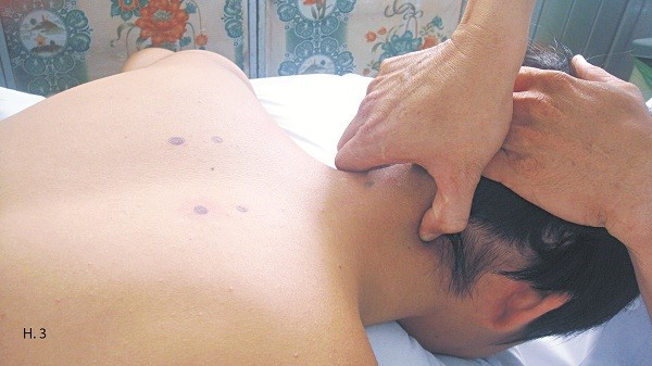 Xoa bóp chữa đau vai gáy hiệu quả ảnh 3