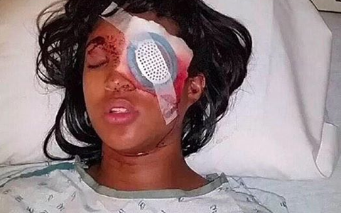 Mải trấn áp biểu tình, cảnh sát làm mù mắt thai phụ ảnh 1