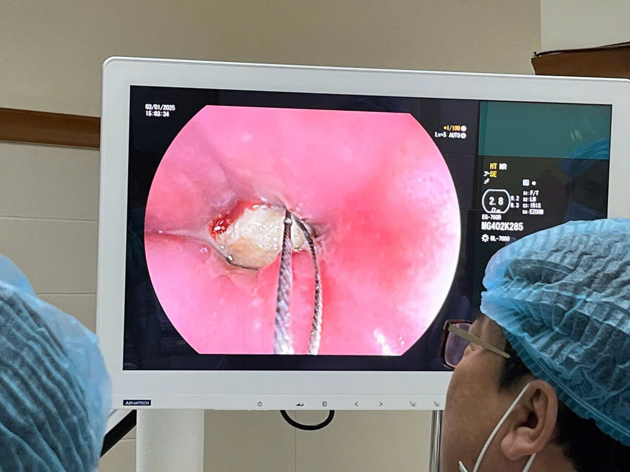 Gắp dị vật ra khỏi thực quản của bệnh nhân. Gắp dị vật ra khỏi thực quản của bệnh nhân.