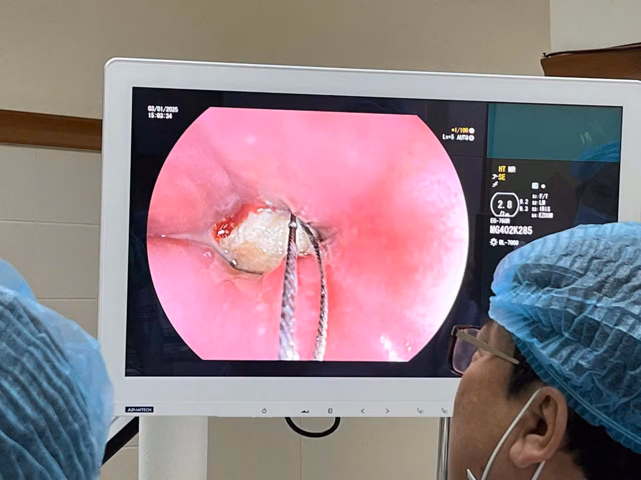 Gắp dị vật ra khỏi thực quản của bệnh nhân.