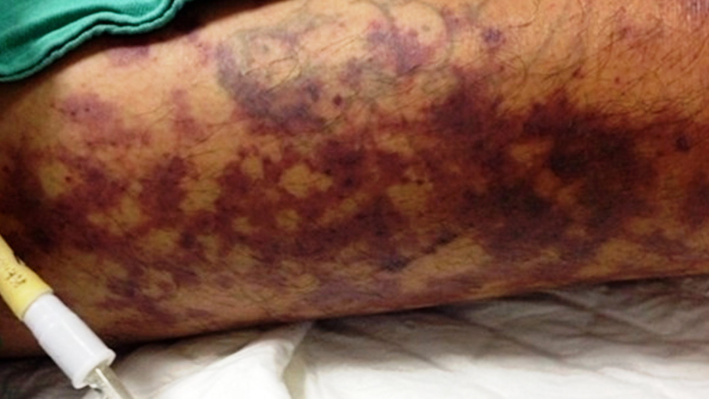 Bệnh nhân mắc bệnh liên cầu lợn xuất hiện tử ban trên da.