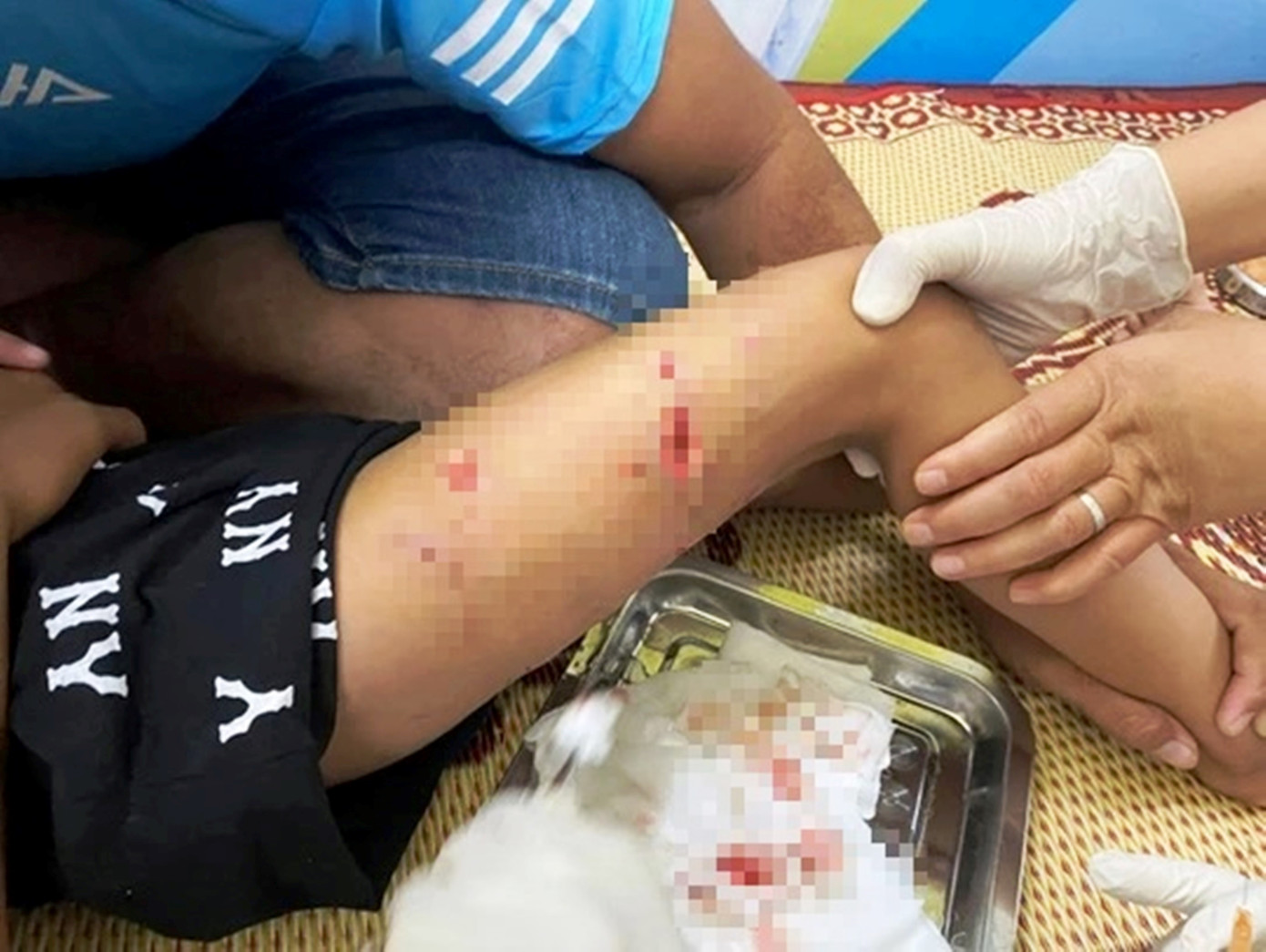 Bác sĩ sơ cứu, xử lý vết thương cho cháu bé 4 tuổi sau khi bị chó dại cắn. (Ảnh: Q.T)