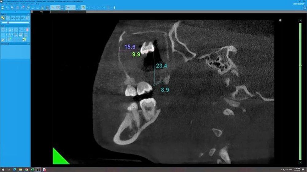 Răng khôn mọc "lạc chỗ" nằm lâu trong xoang hàm kích thước 6 x 7 x 14 mm qua hình ảnh chụp X-quang.