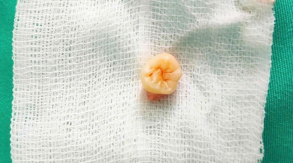 Chiếc răng khôn mọc "lạc chỗ" gây đau đớn cho bệnh nhân trong thời gian dài đã được phẫu thuật, lấy ra khỏi cơ thể.