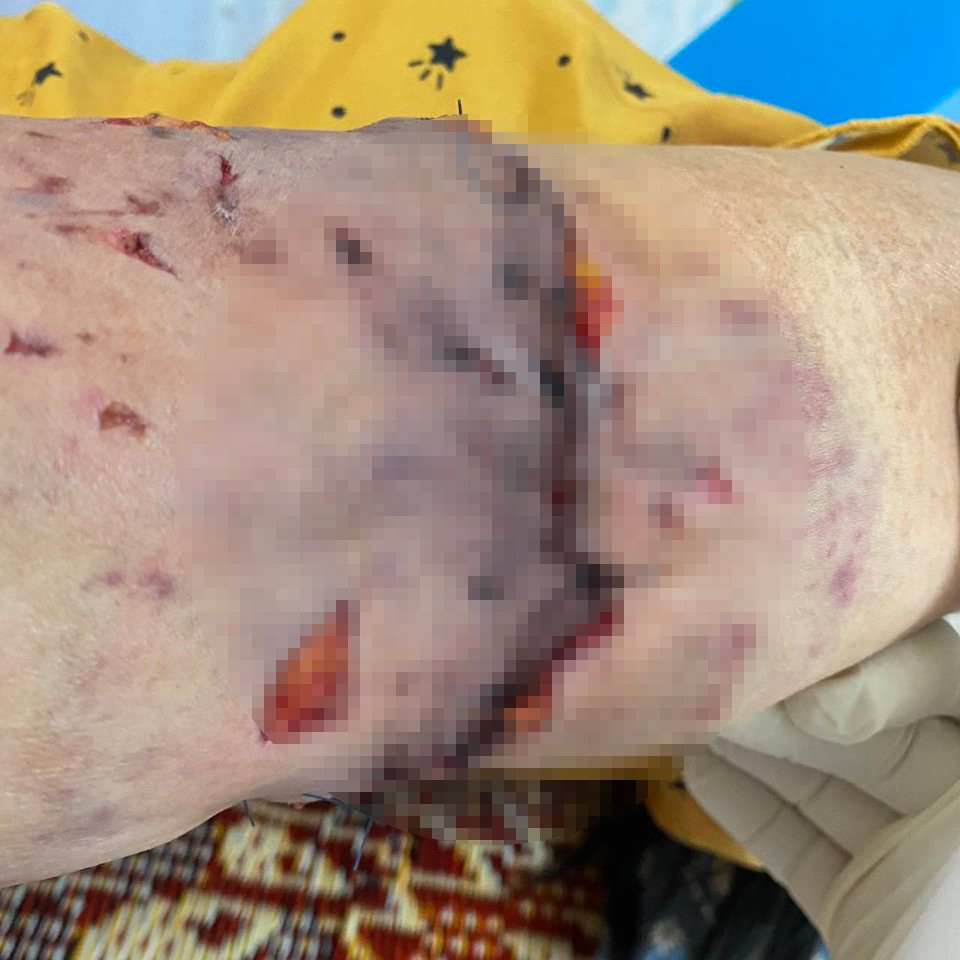 Vòng cánh tay trái của bệnh nhân S. bị chó cắn rách gần hết.