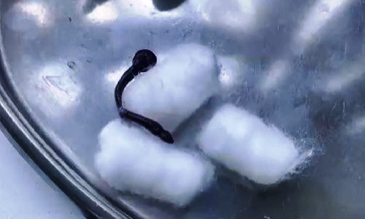 Dị vật đỉa ký sinh bên trong mũi nữ bệnh nhân người dân tộc thiểu số ở huyện miền núi A Lưới. Ảnh: CTV