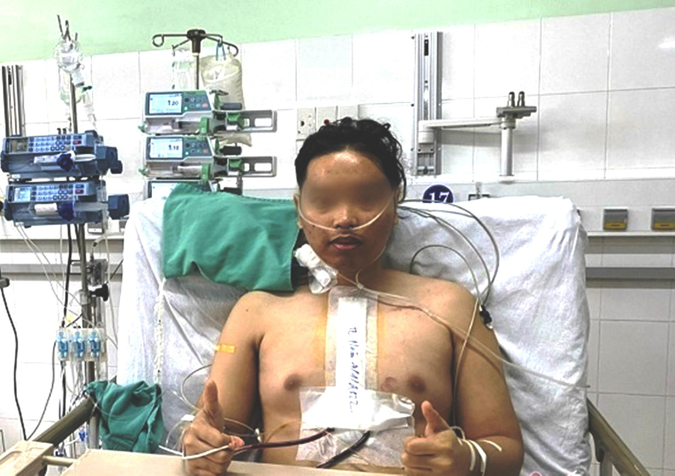 Bệnh nhân Q. hồi phục nhanh sau ca phẫu thuật ghép tạng thành công tại Bệnh viện Trung ương Huế. Bệnh nhân Q. hồi phục nhanh sau ca phẫu thuật ghép tạng thành công tại Bệnh viện Trung ương Huế.