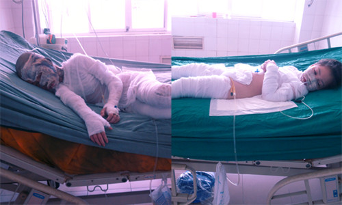 Hai cháu Quỳnh Trang và Quỳnh Anh đang điều trị tại Khoa Hồi sức cấp cứu, Viện Bỏng quốc gia. Ảnh: TN