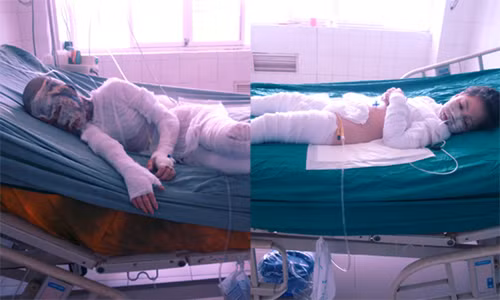 Hai cháu Quỳnh Trang và Quỳnh Anh đang điều trị tại Khoa Hồi sức cấp cứu, Viện Bỏng quốc gia. Ảnh: TN