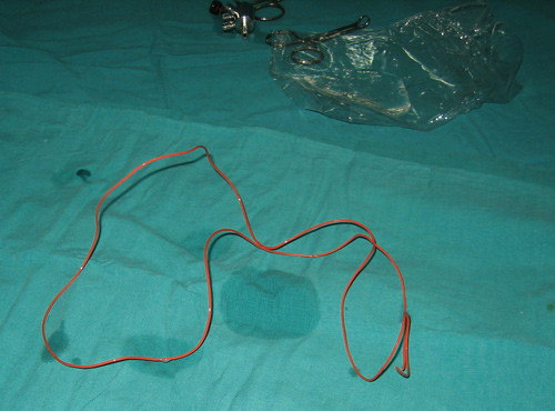 Dị vật được lấy ra khỏi bàng quang của P.