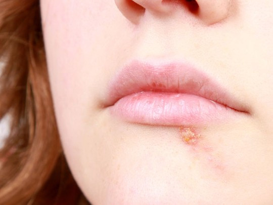 5 cách tự nhiên chữa mụn rộp ở “vùng khó nói”