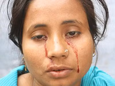 Những giọt máu ở khóe mắt của cô Rashida Khatoon