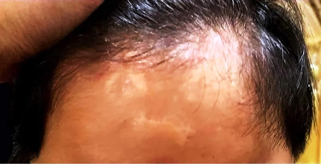 Thương tích trên cơ thể cháu T. nghi do bị bạo hành trong quá trình được ông L.M.Q nhận trị bệnh chậm phát triển. Ảnh gia đình cung cấp. Thương tích trên cơ thể cháu T. nghi do bị bạo hành trong quá trình được ông L.M.Q nhận trị bệnh chậm phát triển. Ảnh gia đình cung cấp.