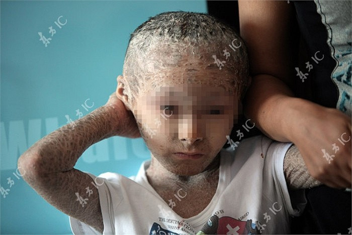 Được biết, mỗi năm trên thế giới có khoảng 16,000 trẻ em sinh ra mắc căn bệnh này