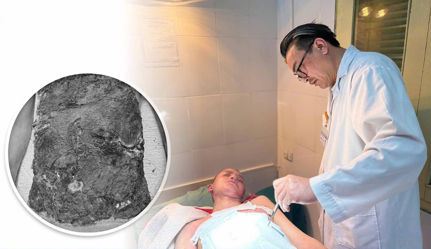 Các bác sĩ đã tiến hành cắt lọc phần da hoại tử, chờ ghép da tự thân.