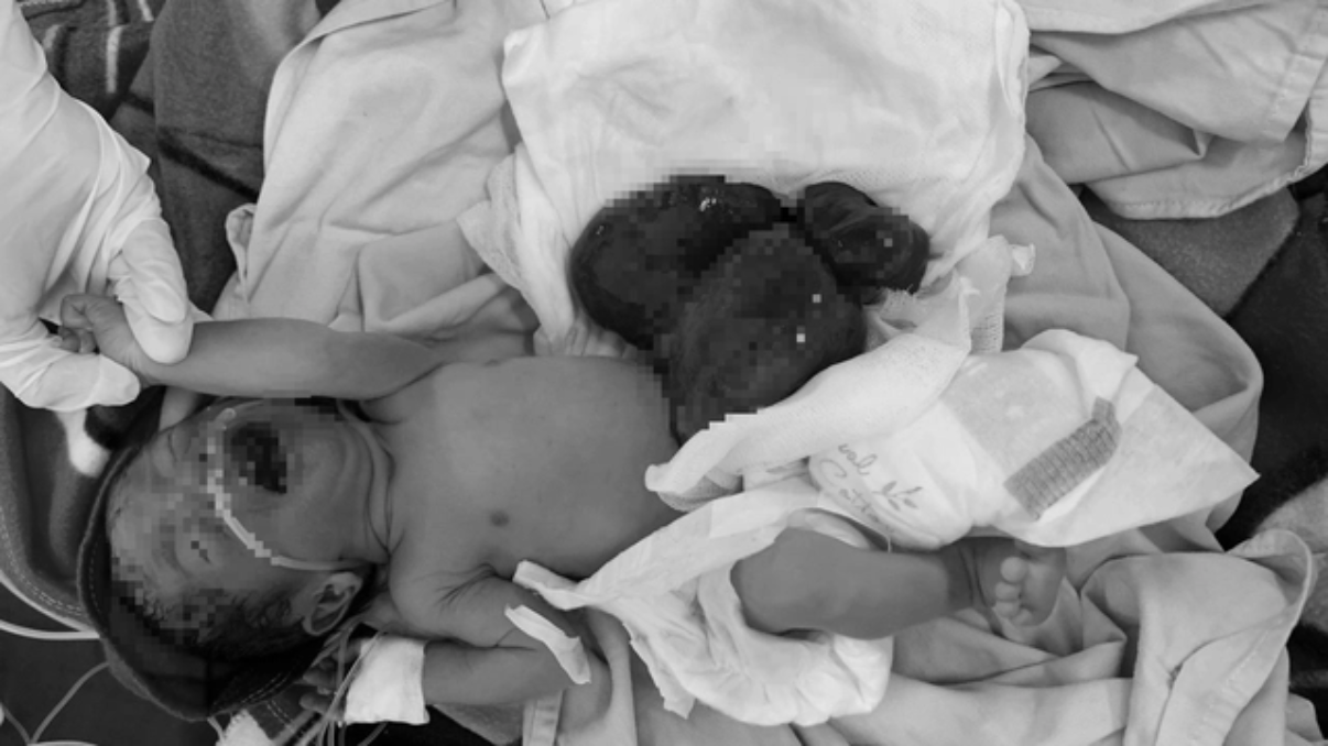 Cháu bé bị dị tật với nội tạng nằm ngoài ổ bụng.