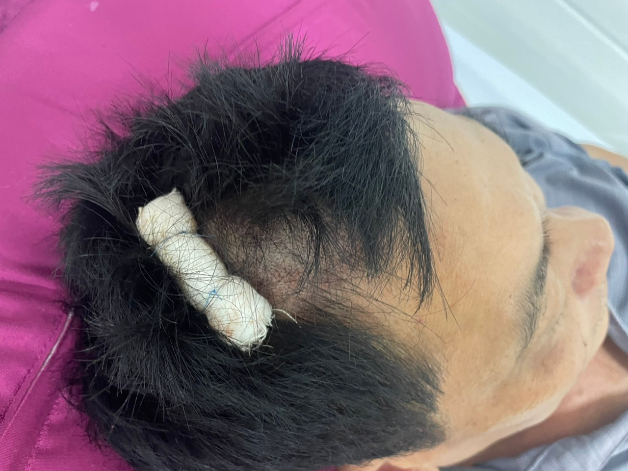 Ông H. được khâu 5 mũi vết thương trên đầu.