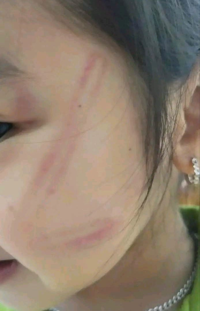 6 cháu bé mầm non lớp 5 tuổi trường mầm non xã Nghĩa Lộc (Nghĩa Đàn, Nghệ An) đã bị bạn dùng đồ chơi đánh bầm tím nhiều nơi trên cơ thể.