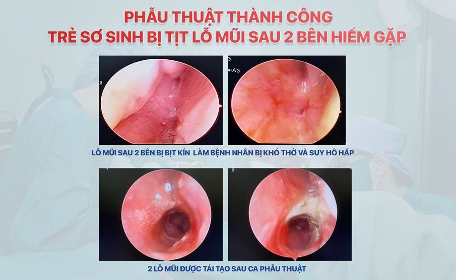 Hình ảnh lỗ mũi cháu bé trước và sau khi được phẫu thuật.
