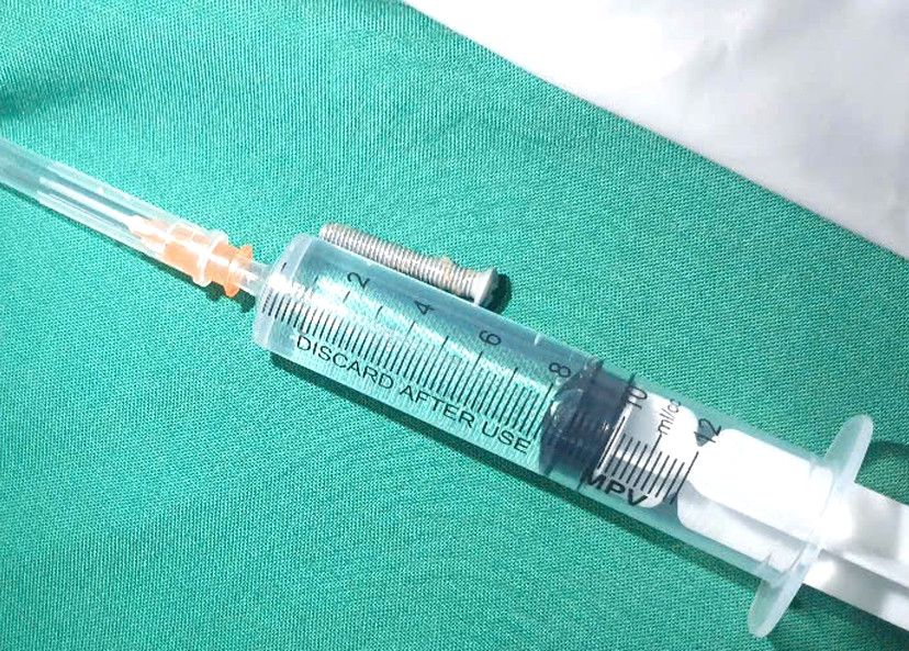 Đinh vít sắt dài 5cm được gắp ra ngoài an toàn.