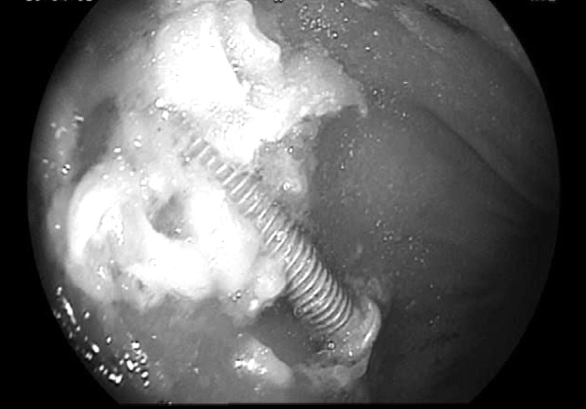 Hình ảnh nội soi dị vật nằm trong dạ dày cháu bé.