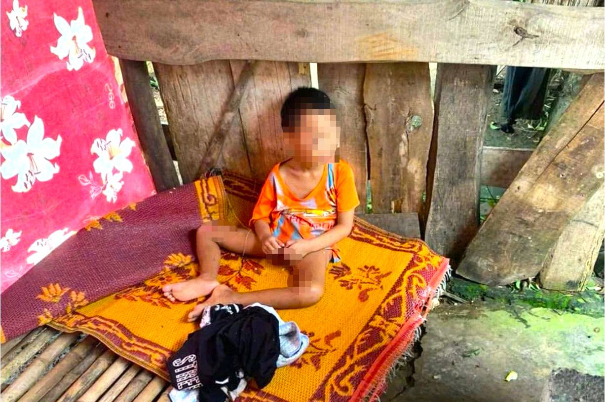 Khi chính quyền xã đến, cháu H. đang ở một mình trong lán tạm, trên cơ thể có nhiều vết thương lở loét. (Ảnh: Đàm Thủy). Khi chính quyền xã đến, cháu H. đang ở một mình trong lán tạm, trên cơ thể có nhiều vết thương lở loét. (Ảnh: Đàm Thủy).