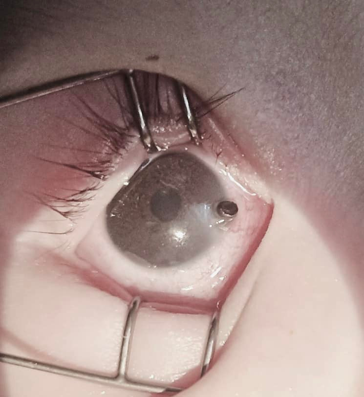 Mắt cháu bé bị ngòi bút chì đâm thủng nhãn cầu mắt.