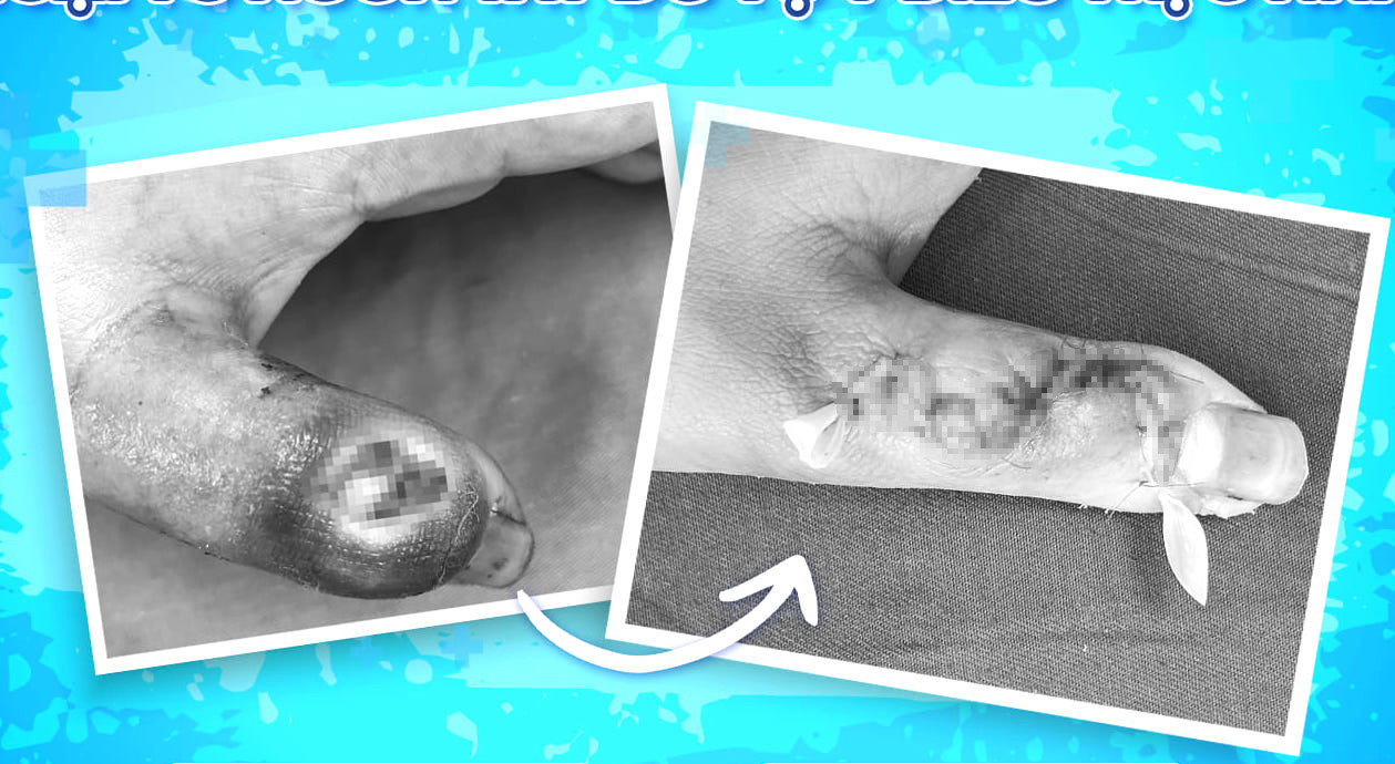 Vết thương của cháu T. bị hoại tử và được các bác sỹ tiến hành phẫu thuật, xử lý để giữ lại ngón tay thành công. Vết thương của cháu T. bị hoại tử và được các bác sỹ tiến hành phẫu thuật, xử lý để giữ lại ngón tay thành công.