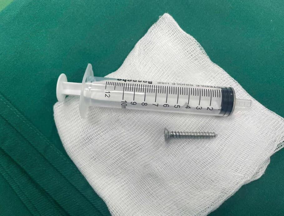 Các bác sĩ tiến hành nội soi và gắp thành công chiếc đinh vít sắc nhọn ra ngoài phổi cho bệnh nhân.