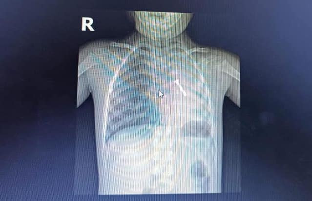 Hình ảnh chụp X-Quang cho thấy, một chiếc đinh vít bị kẹt trong phổi trái của cháu bé.