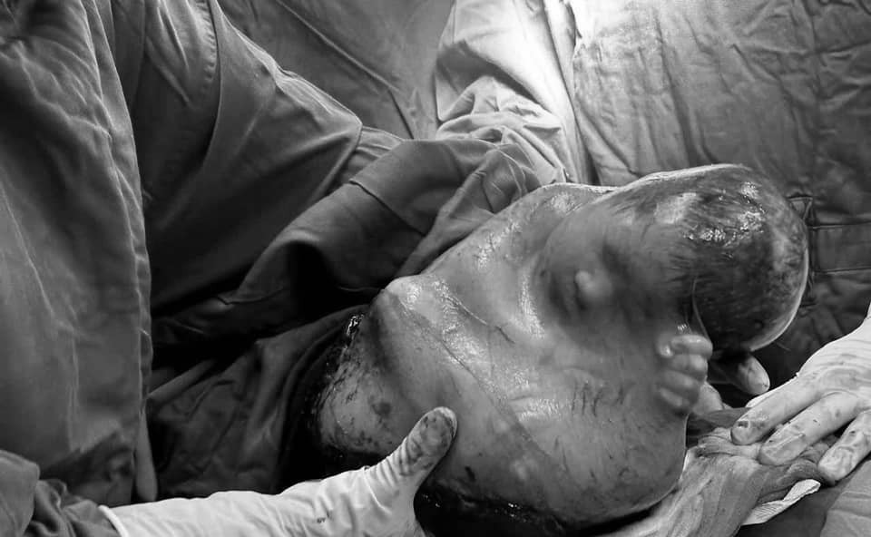 Đây là trường hợp hiếm gặp chiếm tỷ lệ 1/80.000 ca sinh và được xem là may mắn.