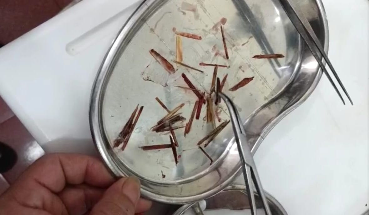 33 que nứa được gắp ra khỏi mũi của bệnh nhân V. 33 que nứa được gắp ra khỏi mũi của bệnh nhân V.