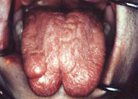 Lưỡi sau khi được 