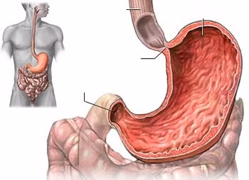 Giãn dạ dày do rối loạn chức năng