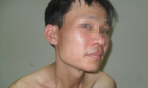 Mới chuyển về nhà mới được gần 2 tuần, anh Huy đã 2 lần bị kiến ba khoang đốt