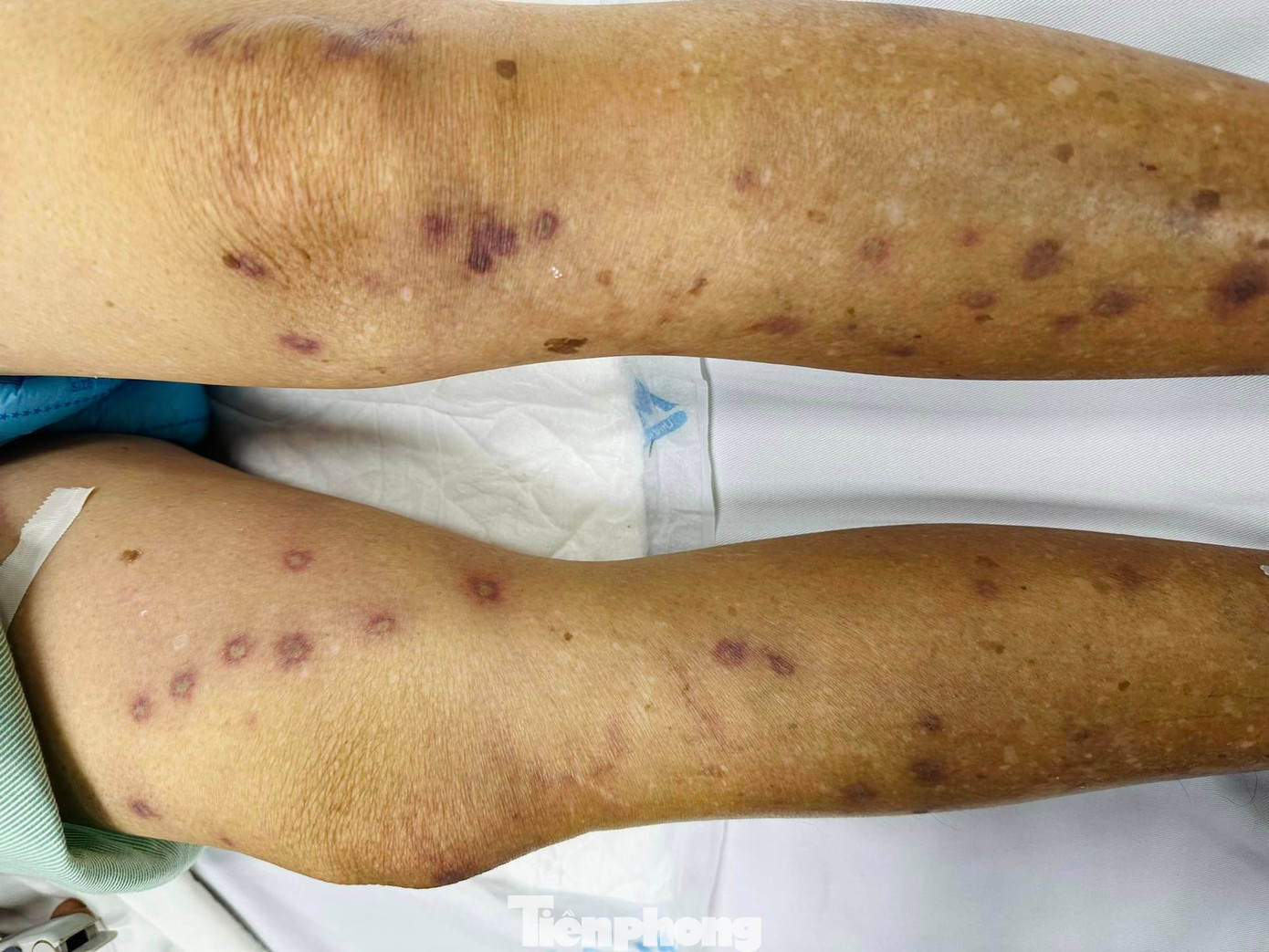 Cụ bà 61 tuổi bị ong đốt chi chít trên chân, hiện đang cấp cứu tại bệnh viện.