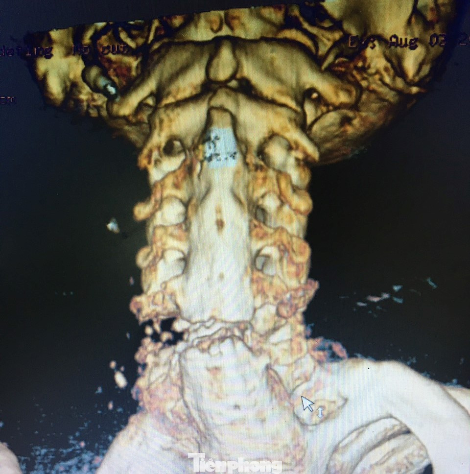 Nhiều người bị rạn đốt sống cổ, rất nguy hiểm. Ảnh: BV