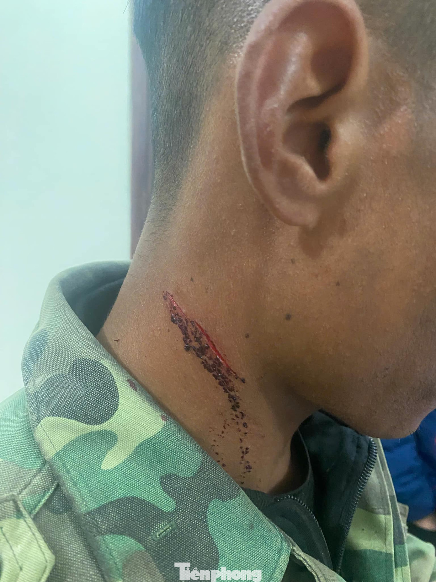 Lợi dụng vết thương cũ, ông V đã cào cho rỉ máu để ngụy tạo bị cướp tấn công.