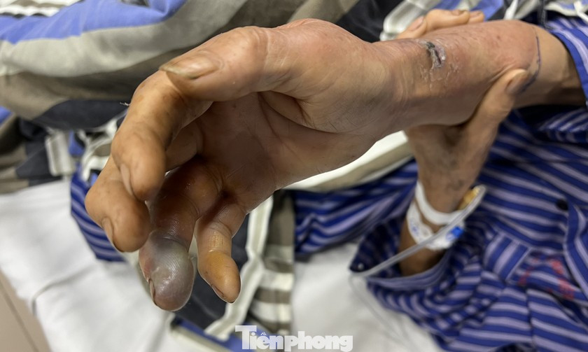 Một nạn nhân bị rắn độc cắn vào tay. Ảnh: TL Một nạn nhân bị rắn độc cắn vào tay. Ảnh: TL